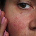 Reducing Inflammation and Redness with Peptides