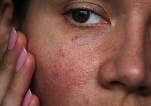 Reducing Inflammation and Redness with Peptides